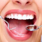 بهترین نوع لمینیت دندان