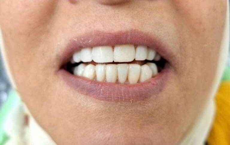 دندانپزشک لمینت وکیل آباد مشهد