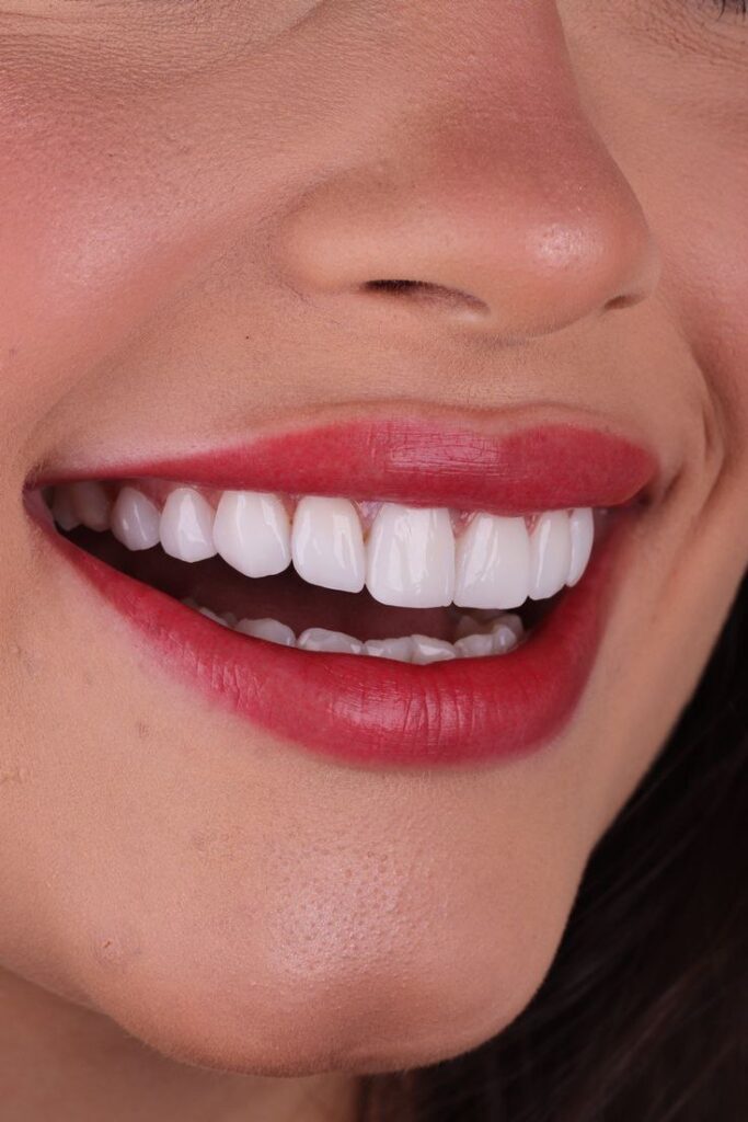 روکش تمام سرامیکی زیرکونیا pfz