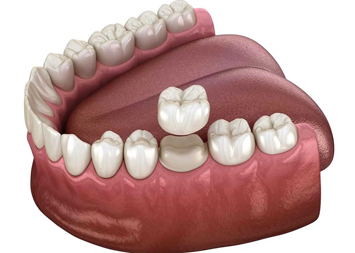 دندانپزشکی اقساطی با دکتر پی