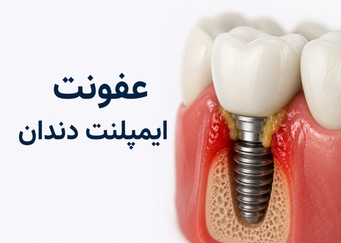 عفونت ایمپلنت دندان