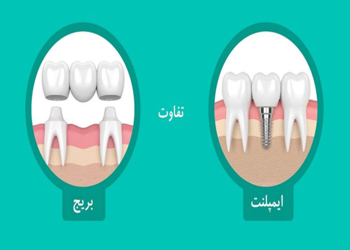 ایمپلنت بهتر است یا بریج