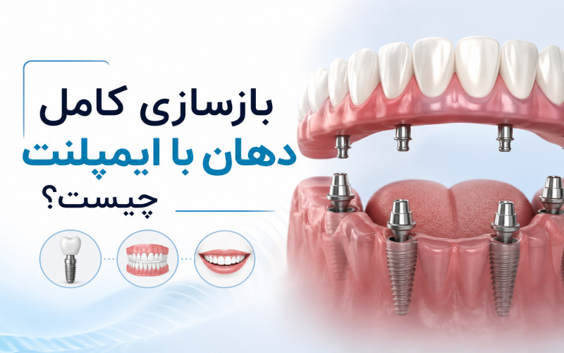 بازسازی کامل دهان با ایمپلنت در غرب مشهد
