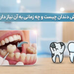روکش دندان