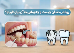 روکش دندان