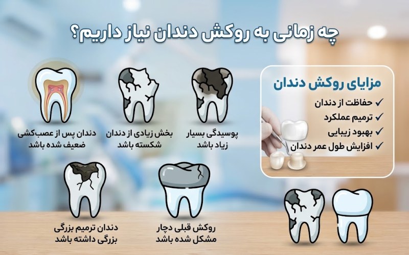 روکش دندان