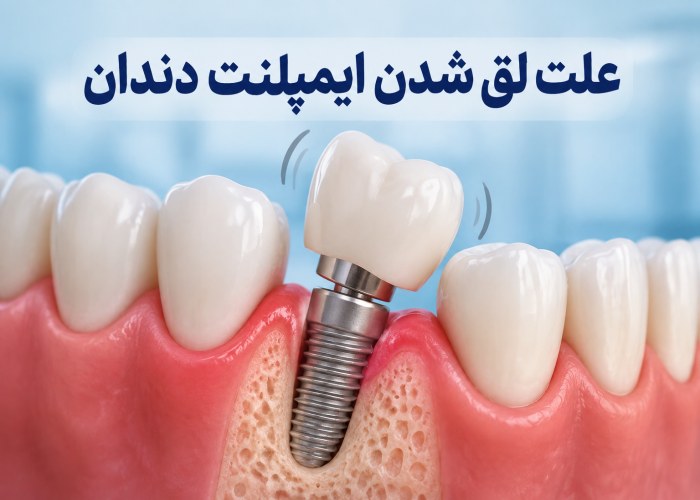 لق شدن ایمپلنت دندان