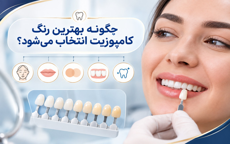 بهترین رنگ کامپوزیت دندان