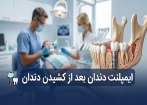 ایمپلنت دندان بعد از کشیدن دندان
