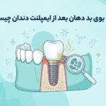 علت بوی بد دهان بعد از ایمپلنت دندان چیست