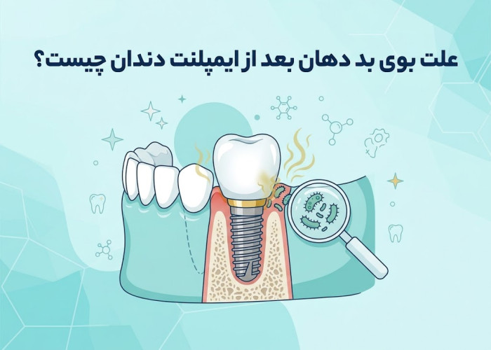 علت بوی بد دهان بعد از ایمپلنت دندان چیست