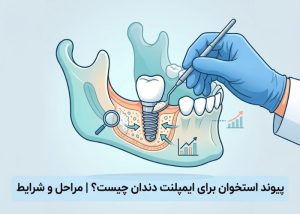 پیوند استخوان برای ایمپلنت