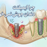 چرا ایمپلنت دندان جوش نمی خورد