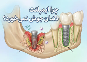چرا ایمپلنت دندان جوش نمی خورد